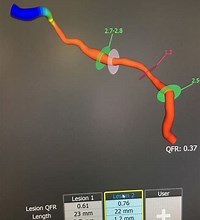 Illustrative coronary reconstruction using QFR