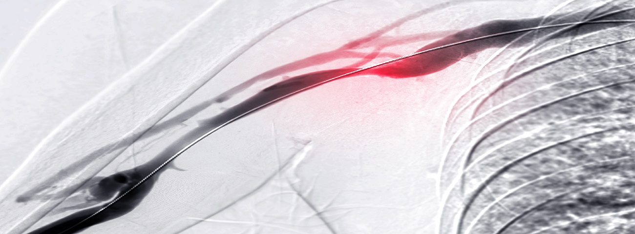 Peripheral Vascular Intervention clinical setting