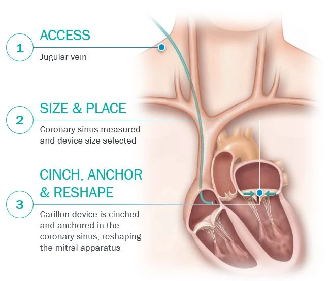 Venous access and delivery catheter