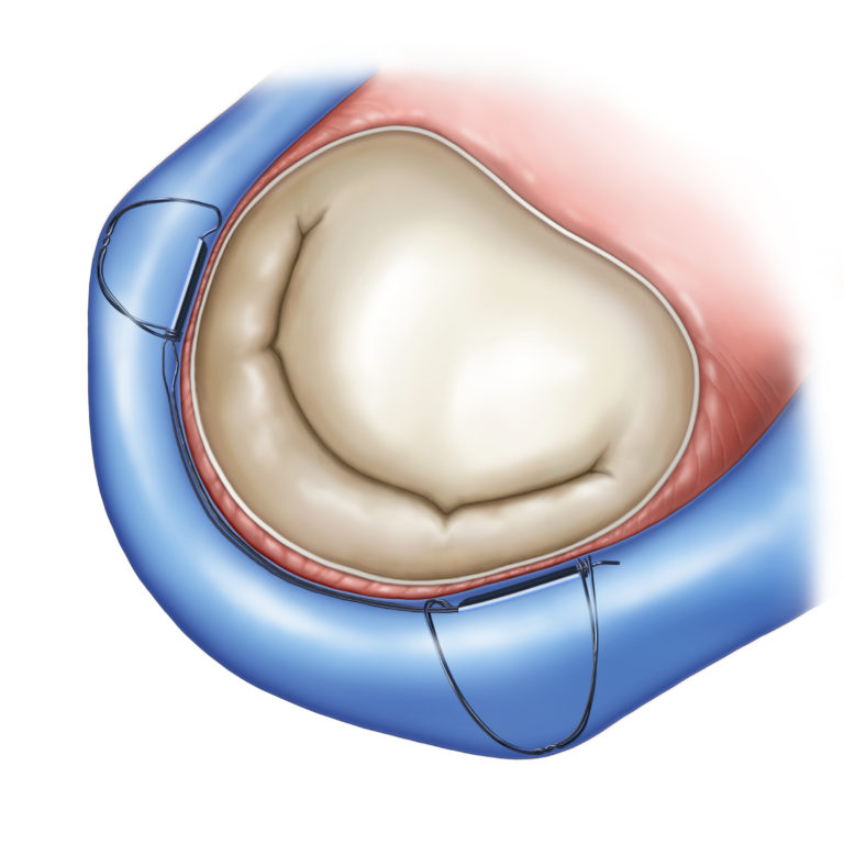 With the CARILLON implant · original illustration