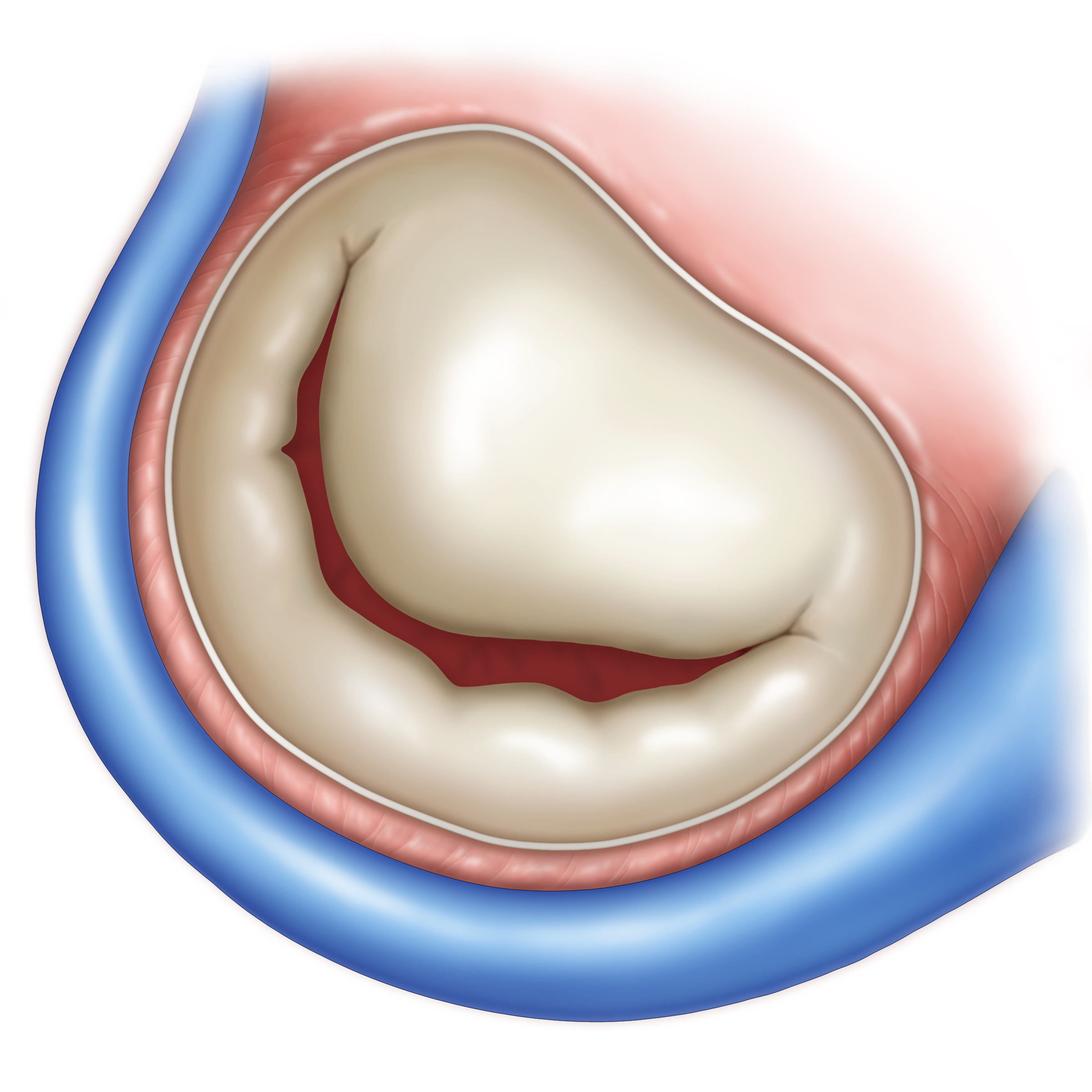 Before implantation · original illustration