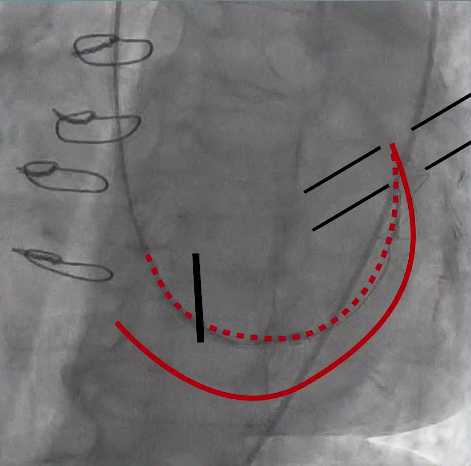 Fluoroscopic sequence · 00:38