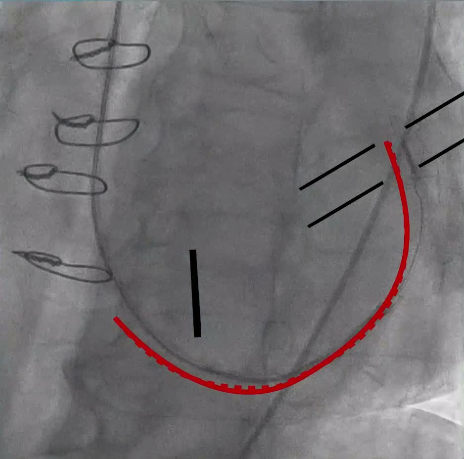 Fluoroscopic sequence · 00:05