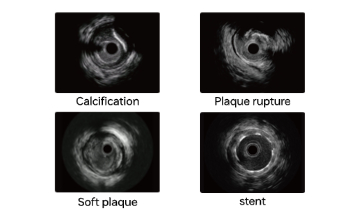iHeartX high-definition IVUS cross-sectional view
