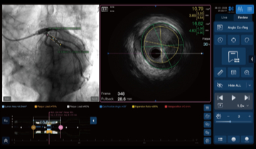 iHeartX Easy Go 2.0 pre-PCI lesion analysis interface